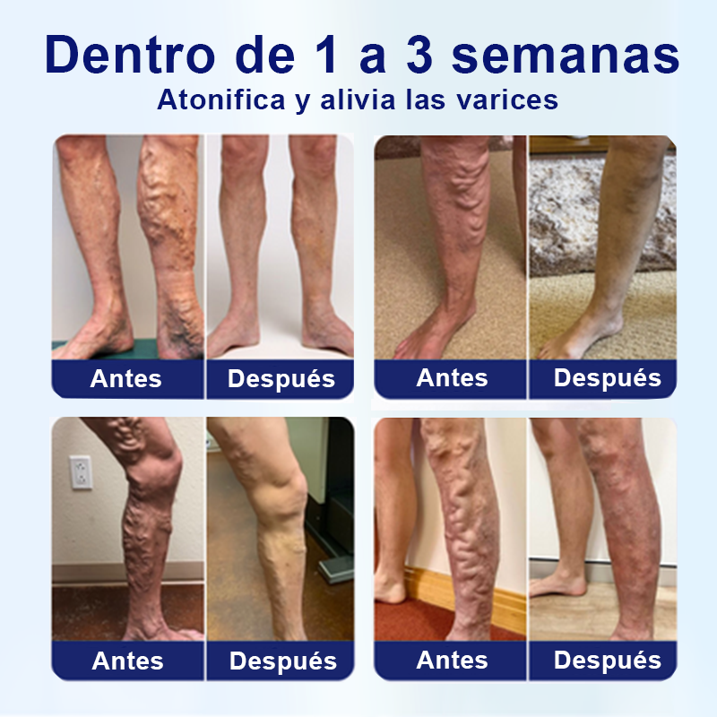 💙Aprobado por la FDA🌿ODEIUN™ VeinFreedom Spray Herbario - Terapia de MicroNiebla