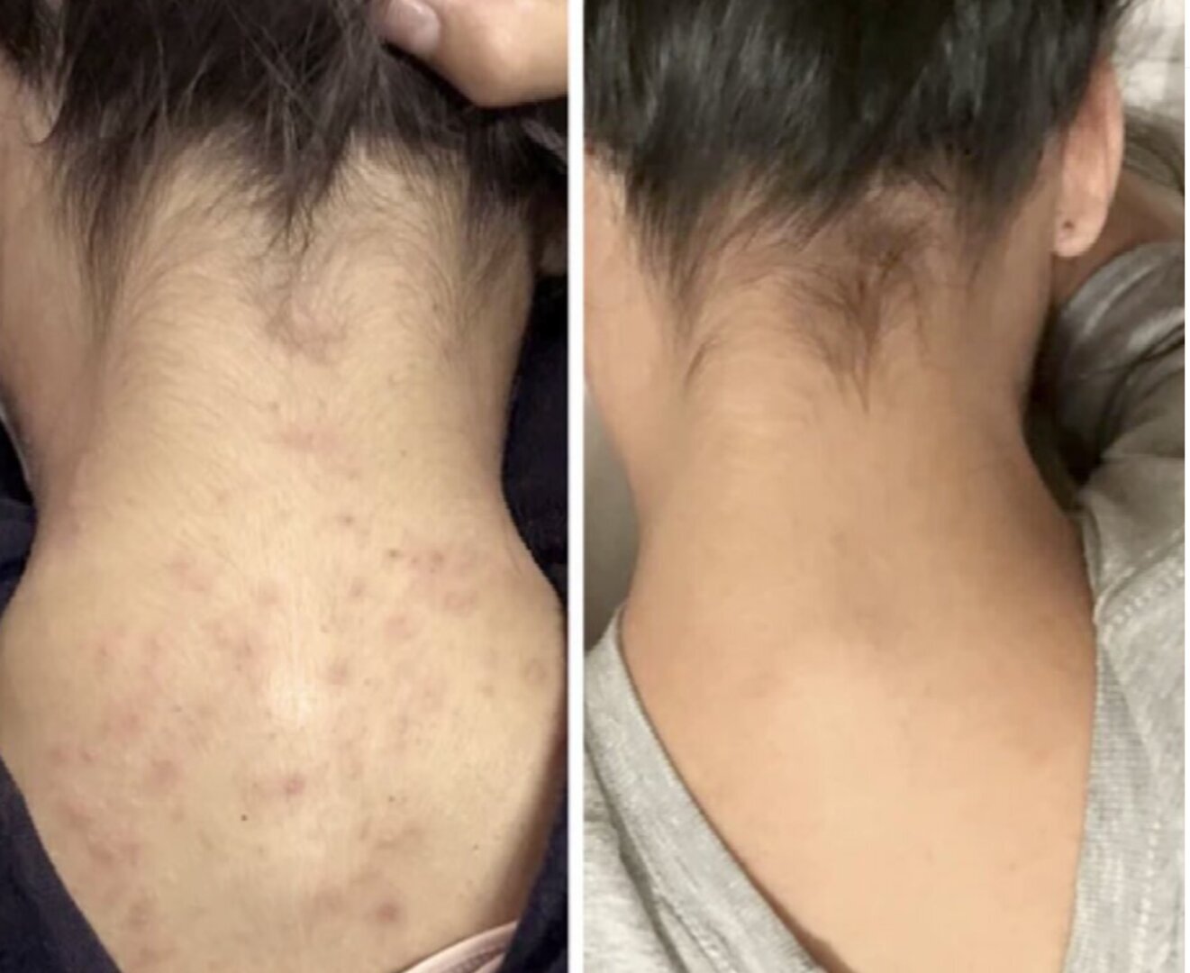 Back neck dark marks before and after customer review