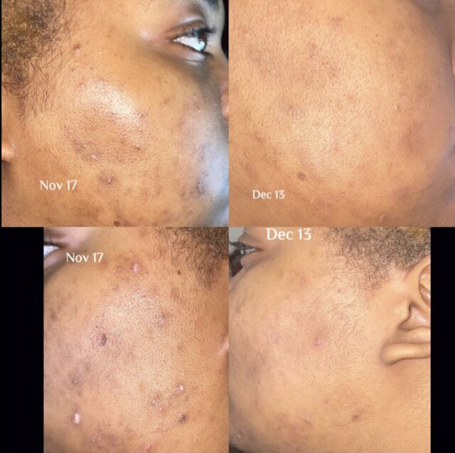 Cheek post blemish marks before and after customer review