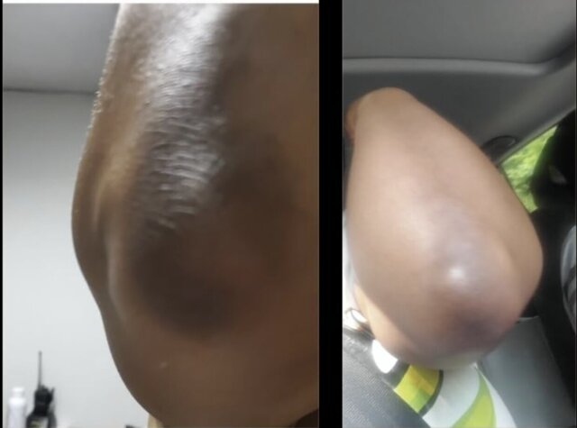 Elbow dark spot before and after customer review