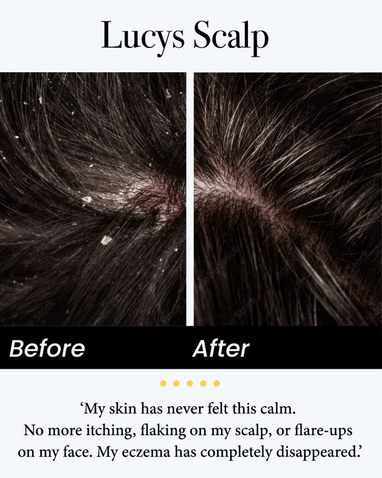 🔥Last Day -49% off🔥JEREMYTIS™ Natural Calming Serum✨